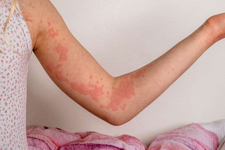The Role of the Immune System in Allergies and Autoimmune Diseases