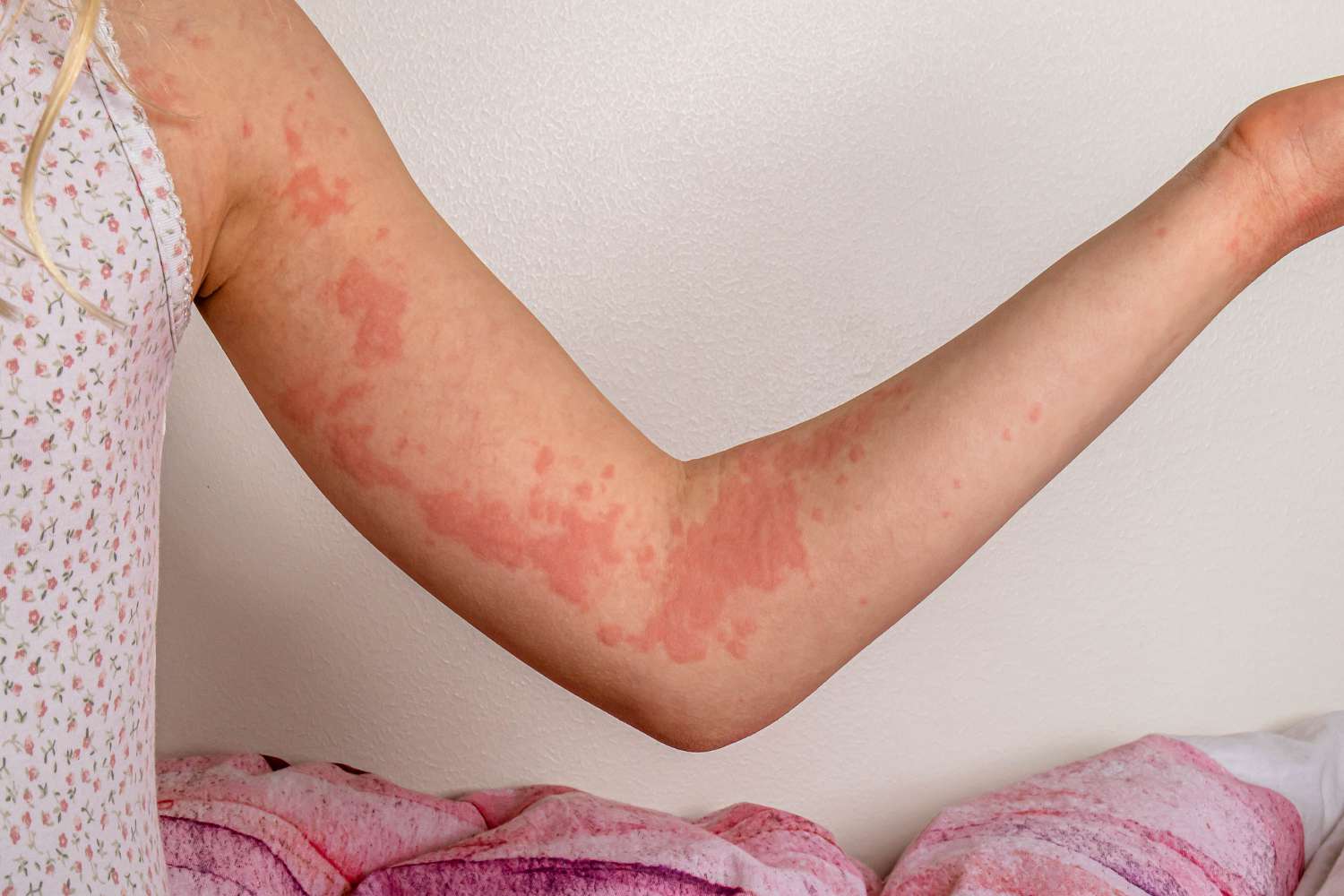 The Role of the Immune System in Allergies and Autoimmune Diseases