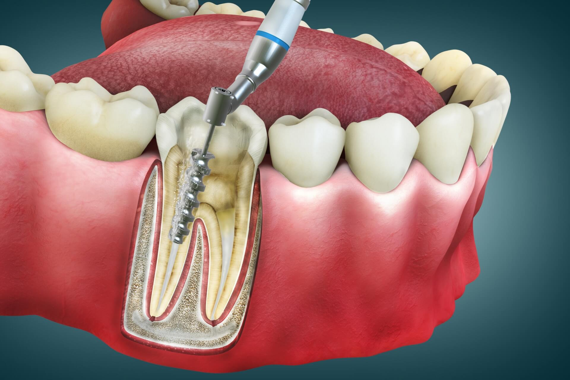 How Long Does a Root Canal Take to Heal