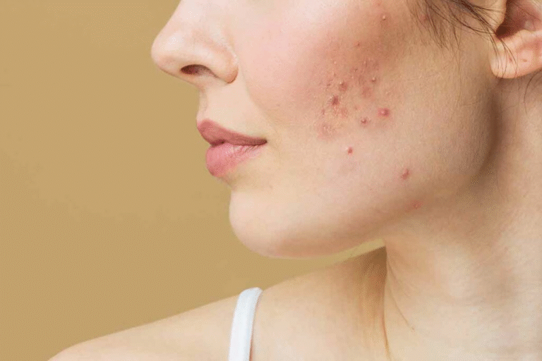 How to Treat Hormonal Acne Naturally Without Medication