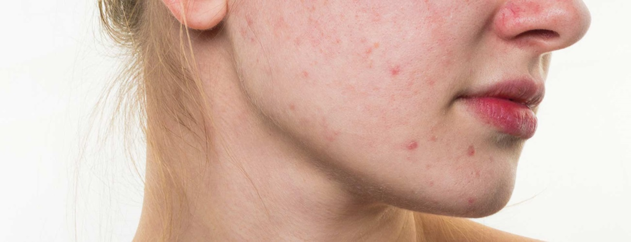 How to Treat Adult Acne Naturally Without Medication