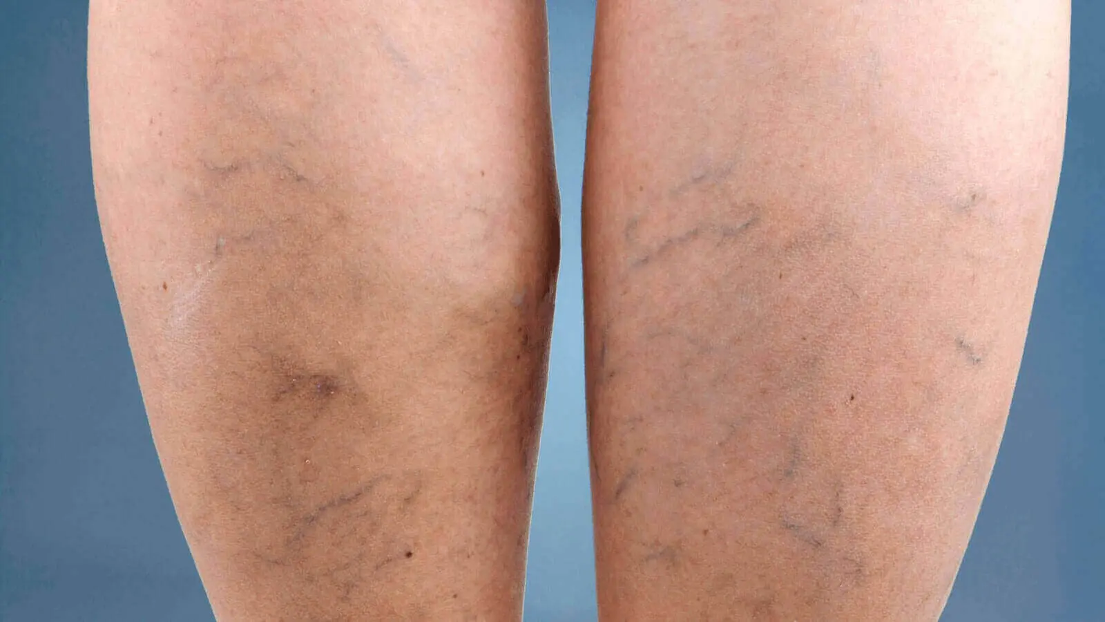 4 Tips for Finding Relief From Varicose Veins 4 Tips for Finding Relief From Varicose Veins