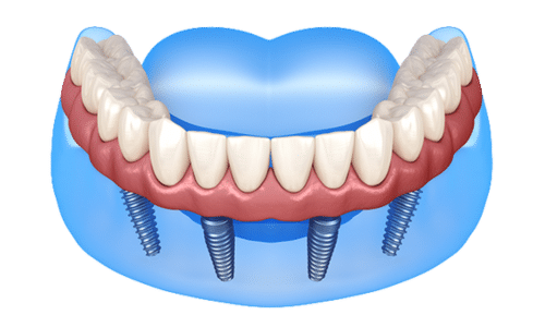 4 Types of Permanent Dental Restorations