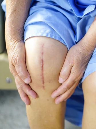 Addressing Pain Management After Knee Replacement Surgery