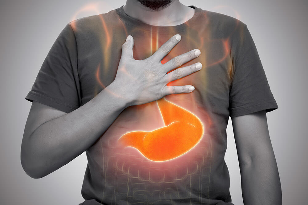 Causes and Treatment Options for Acid Reflux Causes and Treatment Options for Acid Reflux