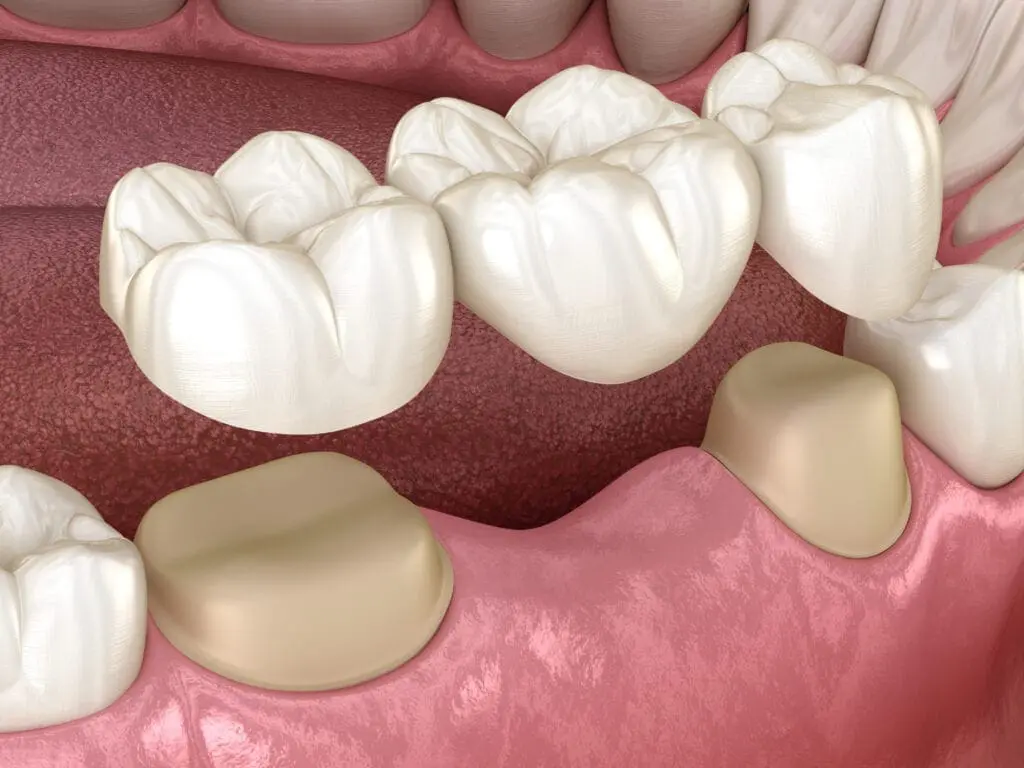 Common Types of Crowns and Bridges and Their Benefits Common Types of Crowns and Bridges and Their Benefits