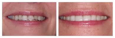 Comparing Different Types of Dental Crowns Comparing Different Types of Dental Crowns