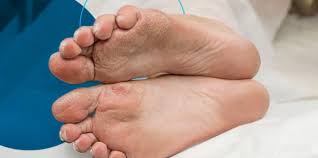 Effective Strategies for Managing Diabetic Wound Care