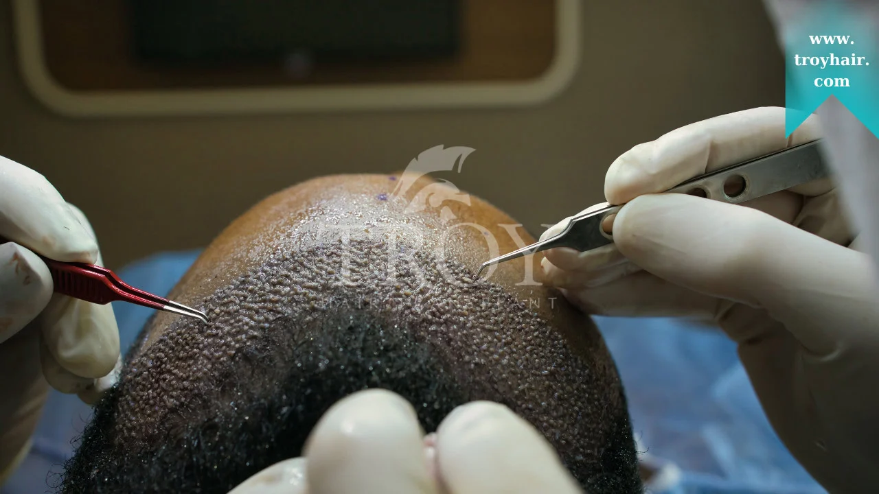 Exploring Advanced Techniques in Hair Restoration
