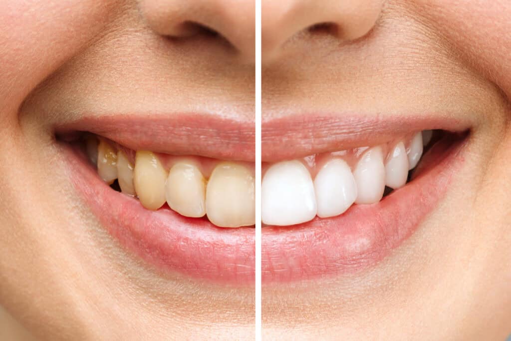 woman teeth before and after whitening. Over white background. Dental clinic patient. Image symbolizes oral care dentistry, stomatology. FAQs About Teeth Whitening