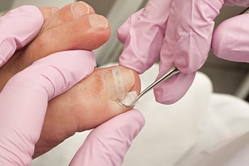 How Will a Doctor Treat Ingrown Toenails How Will a Doctor Treat Ingrown Toenails?