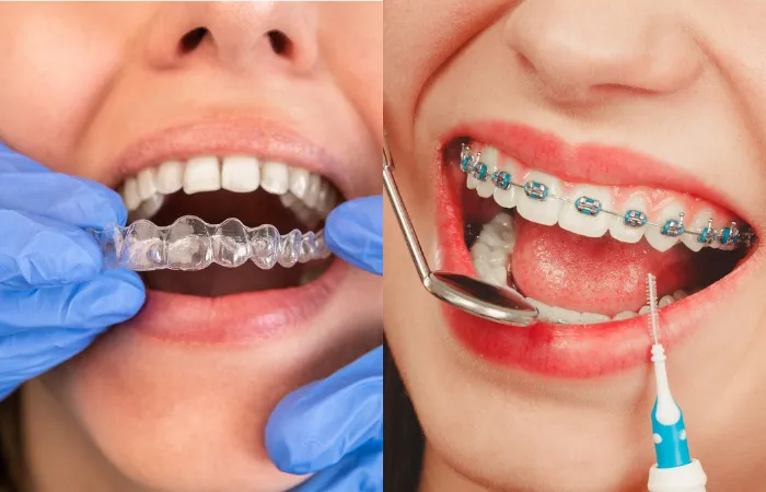 Invisalign Versus Traditional Braces