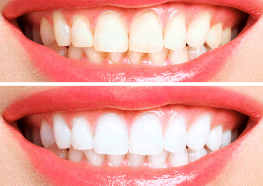 Professional Solutions for Teeth Whitening Professional Solutions for Teeth Whitening