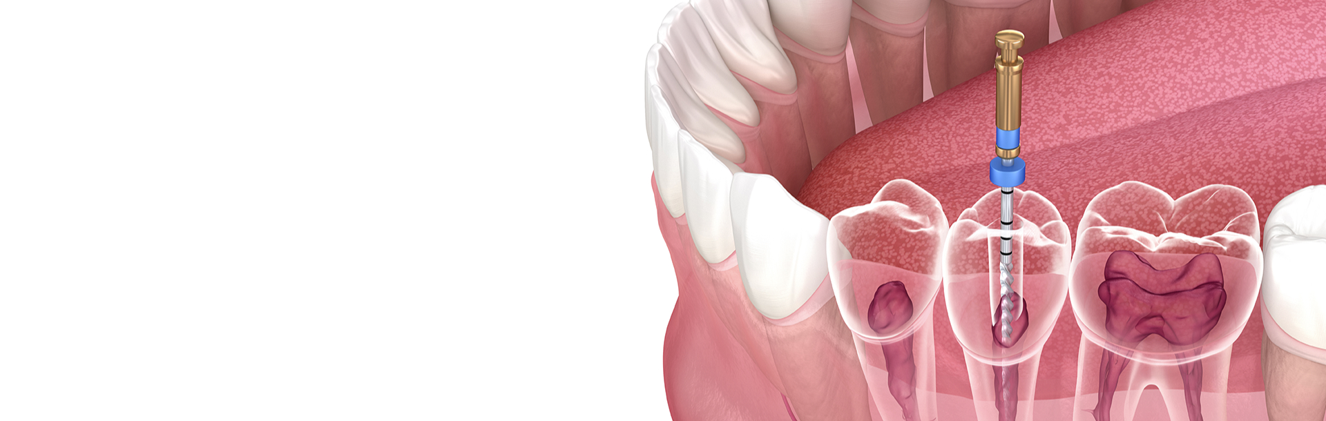 Symptoms Indicating You May Need a Root Canal