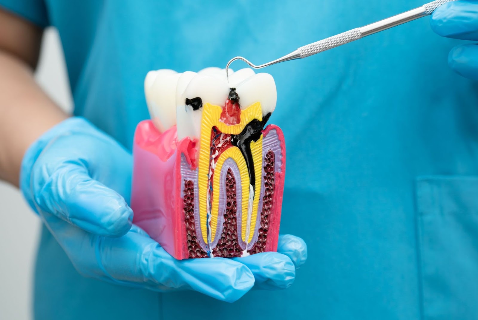 The Benefits of Choosing a Trusted Dentists for Root Canals