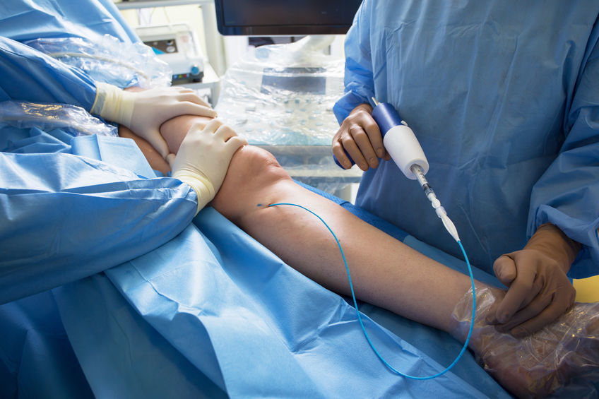 The Connection Between Cardiovascular Health and Varicose Veins