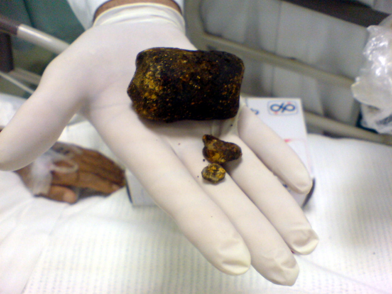 The Role of Gallbladder Removal in Treating Gallstones