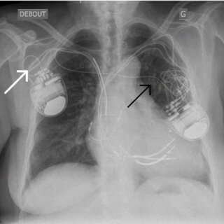 The Role of Pacemakers in Treating Atrial Fibrillation