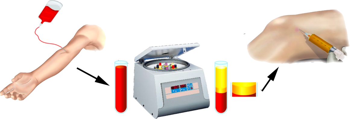 The Science Behind Platelet Rich Plasma Therapy and Its Healing Properties