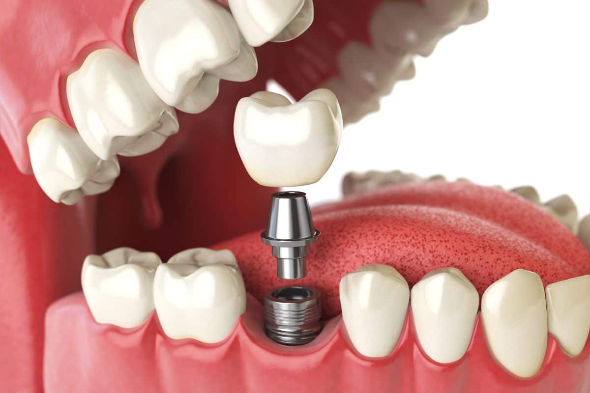 Tips for Maintaining Your Dental Implants Tips for Maintaining Your Dental Implants