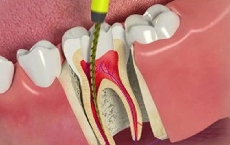 Understanding Pediatric Root Canal Procedures Understanding Pediatric Root Canal Procedures