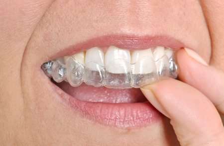 Understanding the Benefits of Invisalign for Adults Understanding the Benefits of Invisalign for Adults