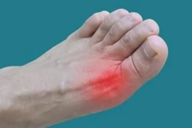 Understanding the Causes and Symptoms of Gout Understanding the Causes and Symptoms of Gout