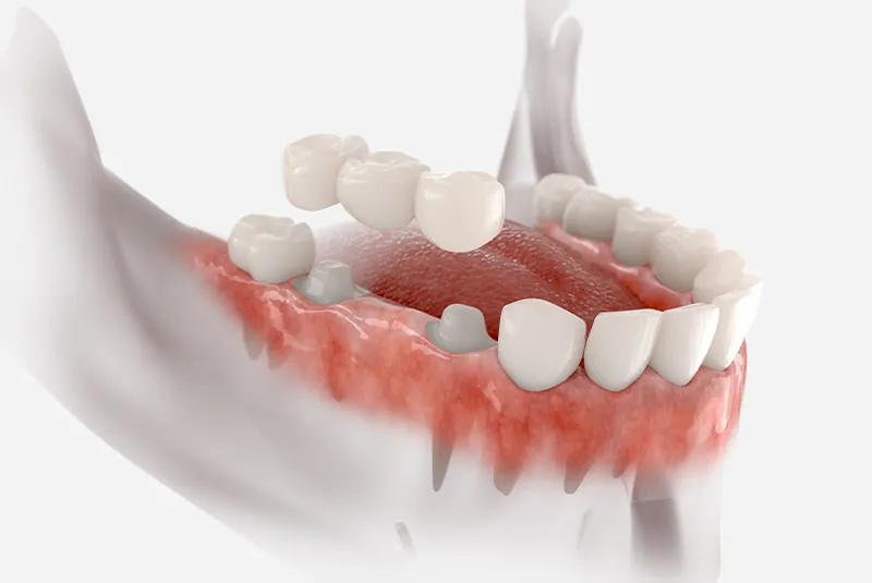 Understanding the Role of Crowns and Bridges in Dental Restoration