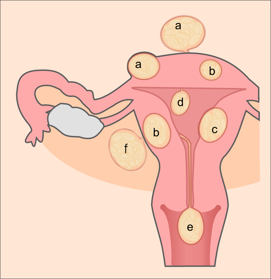 What Are Fibroids?