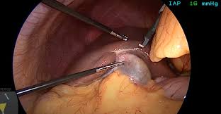 What Is the Process Involved in Gallbladder Surgery?