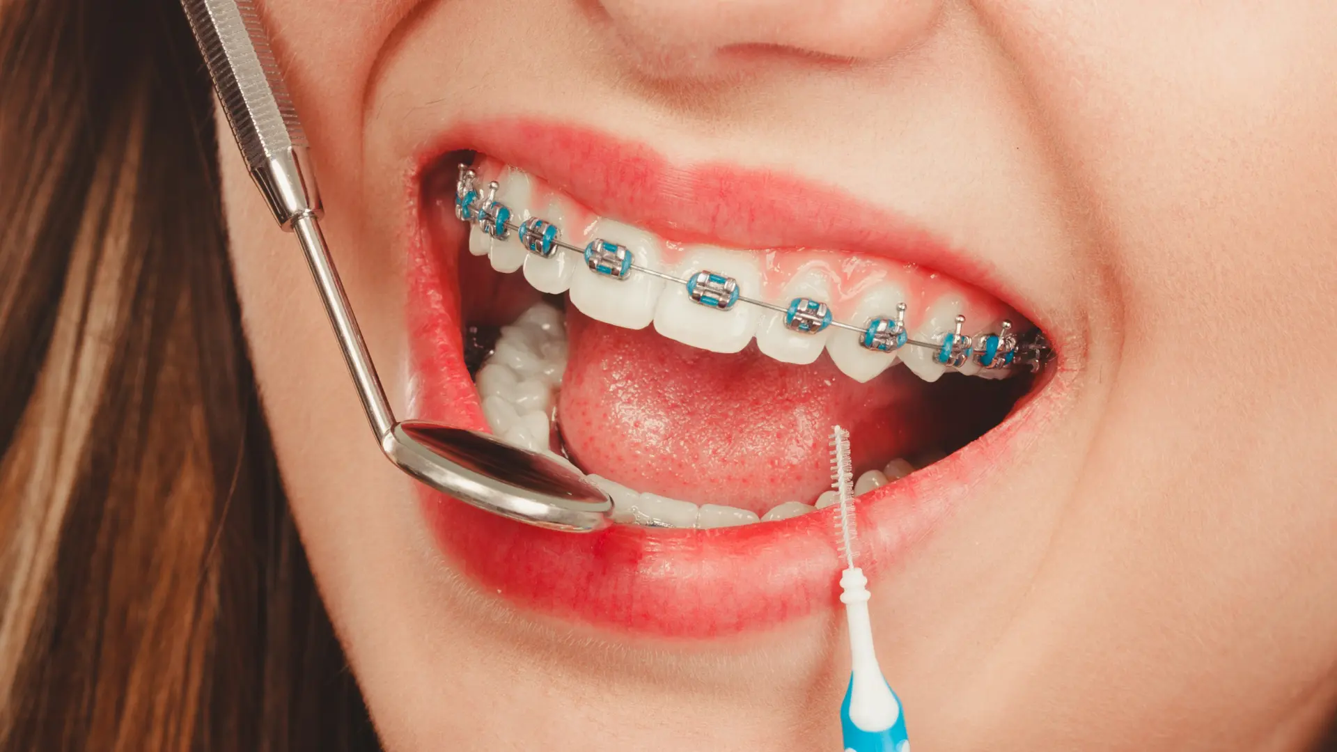 What To Expect on Your First Braces Appointment What To Expect on Your First Braces Appointment