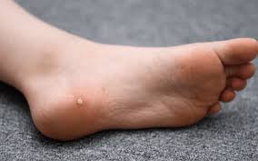 What You Need To Know About Effective Treatments for Plantar Warts What You Need To Know About Effective Treatments for Plantar Warts