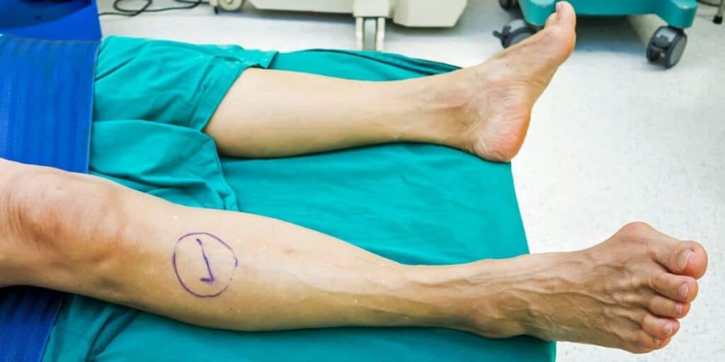 What to Expect During Bunion Surgery