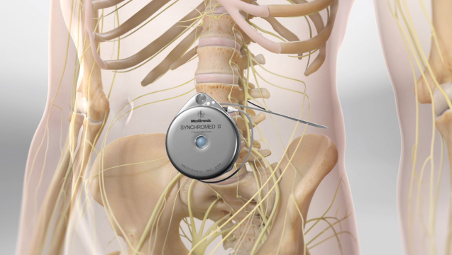 What to Know About Spinal Cord Stimulation