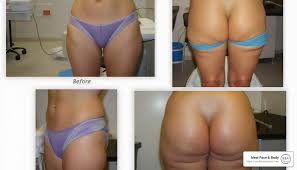 Debunking Common Myths About Liposuction