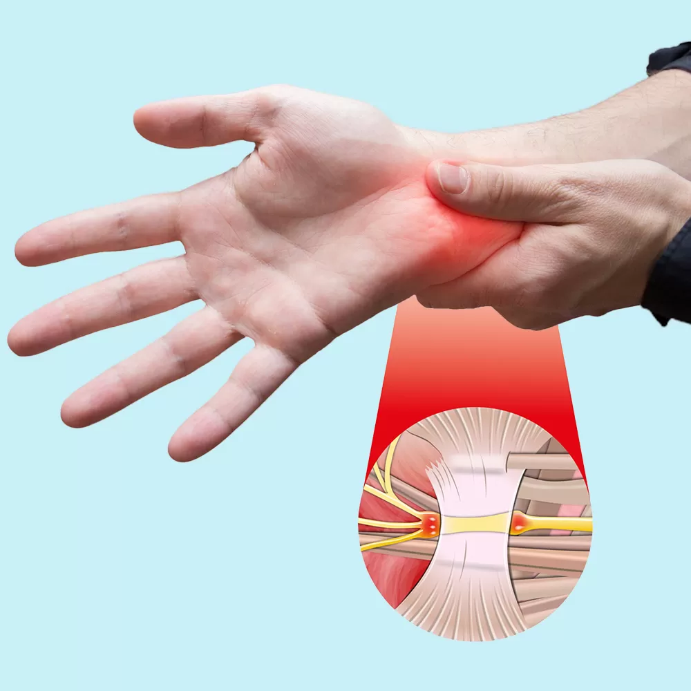 Identifying Carpal Tunnel Syndrome Symptoms Early