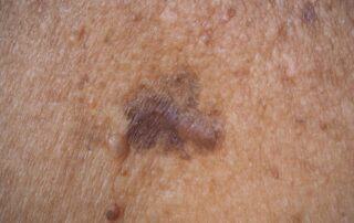Recognizing the Early Signs of Skin Cancer