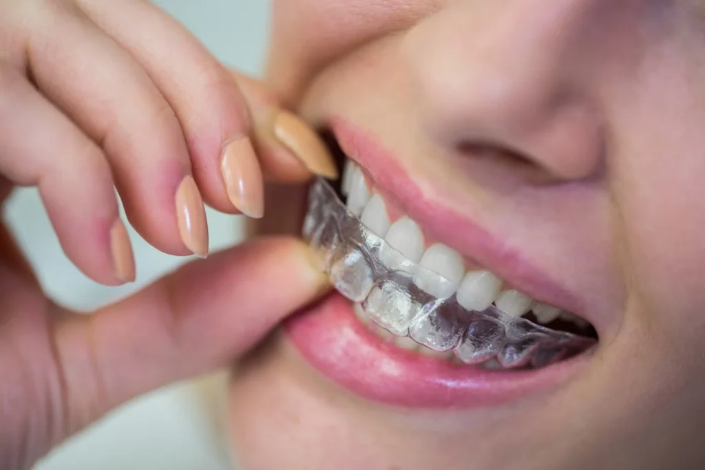 The Advantages of Invisalign® Over Traditional Braces