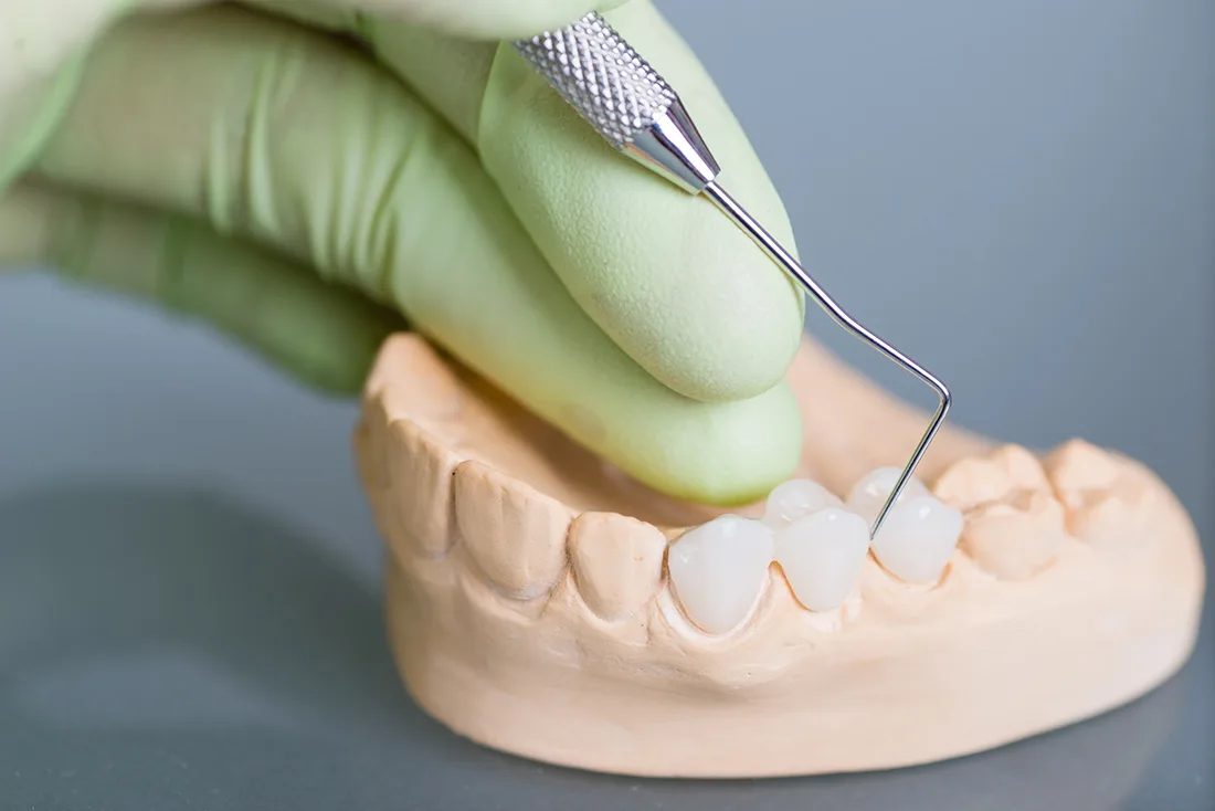 The Process of Getting Dental Crowns