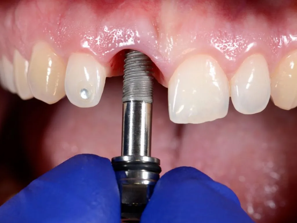 The Step-by-Step Process of Getting Dental Implants