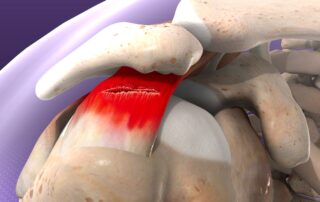 Understanding the Different Types of Rotator Cuff Tears