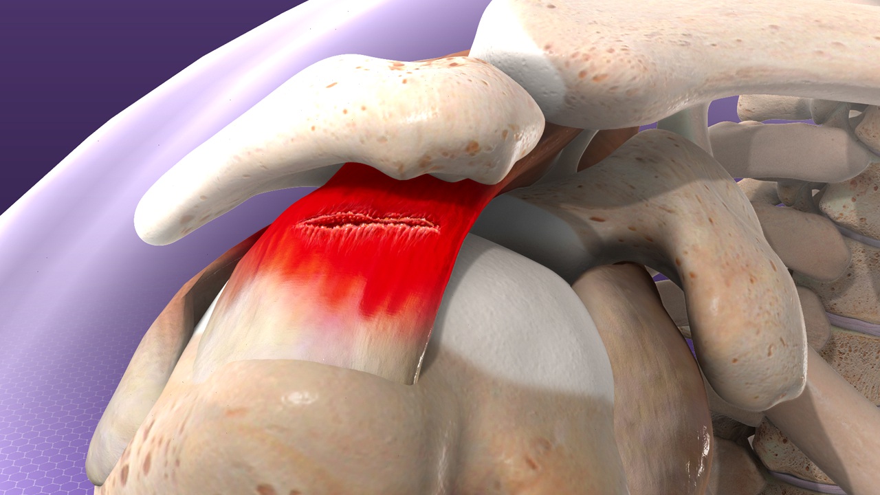 Understanding the Different Types of Rotator Cuff Tears
