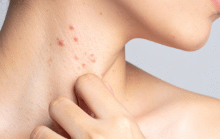 Understanding and Managing Eczema Symptoms