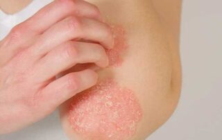 Innovative Eczema Treatment Approaches