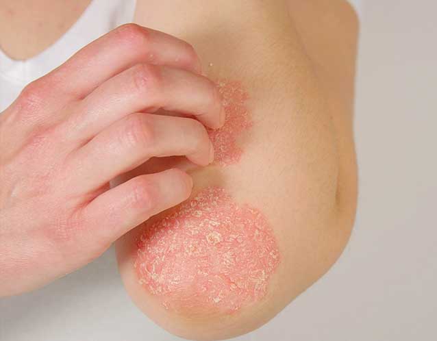 Innovative Eczema Treatment Approaches