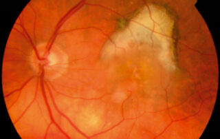 Living With Macular Degeneration