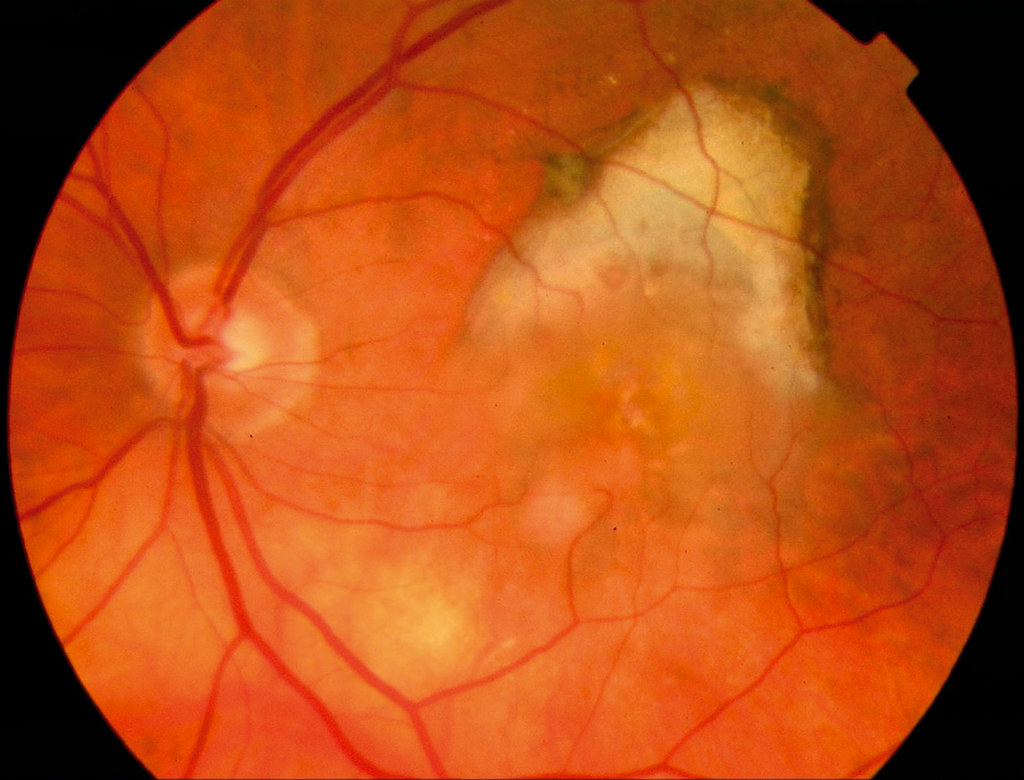 Living With Macular Degeneration