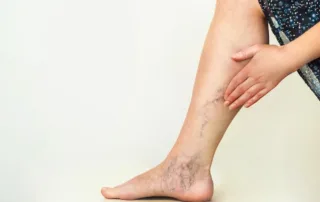 The Connection Between Varicose Veins and Hormonal Changes