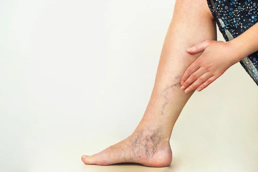 The Connection Between Varicose Veins and Hormonal Changes