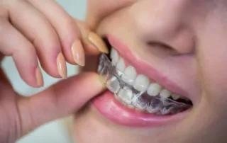 Understanding the Advantages of Clear Braces for Orthodontic Treatment